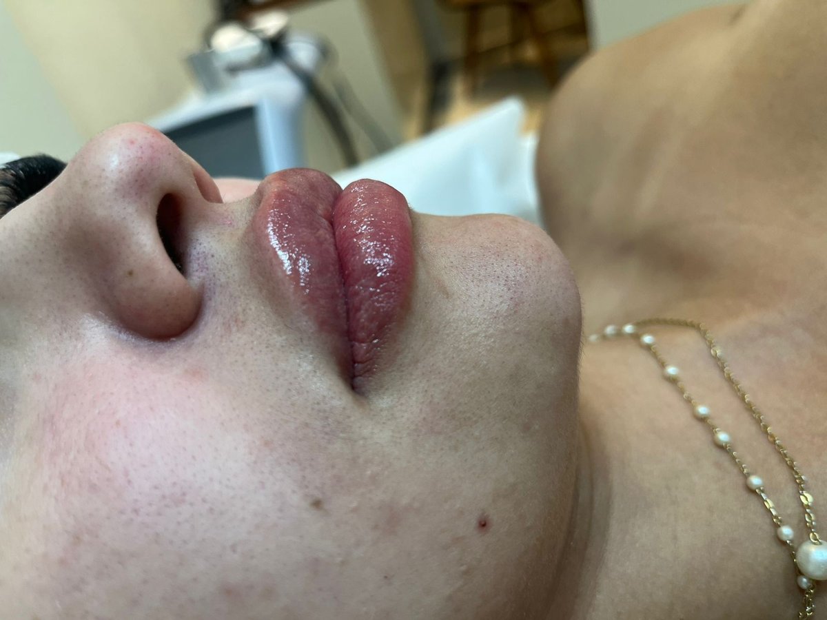 Resultado de preenchimento labial na AC Clinic